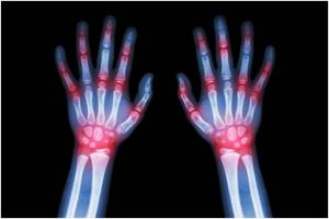 Cracking Knuckles in X-Ray