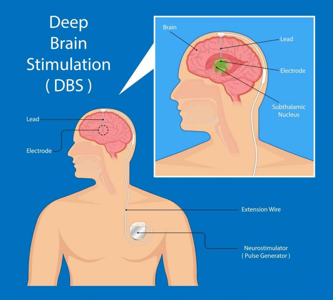 Parkinson s Disease Symptoms And Early Warning Signs Of PD Parkinson s disease symptoms and early warning signs of pd