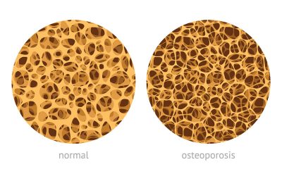 Diet and Osteoporosis: What We Eat Can Affect Bone Health